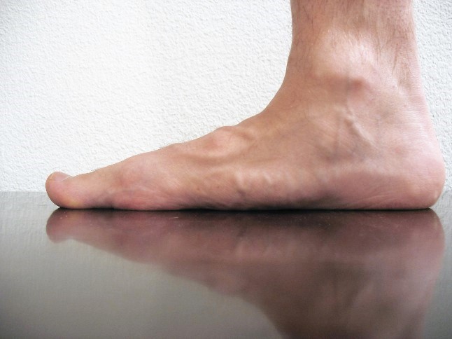 Flat Foot Arch Before Vos pieds vous font régulièrement mal ? C’est forcément l’un de ces graves problèmes de santé