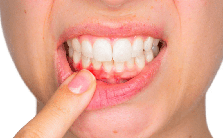 gencive gonflee dentiste e1633541917338