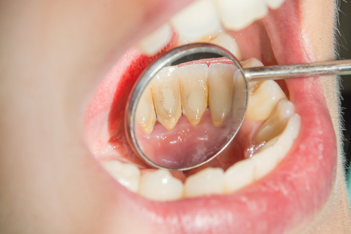 plaque dentaire Vos gencives se gonflent ? Cette horrible maladie peut être à l’origine…