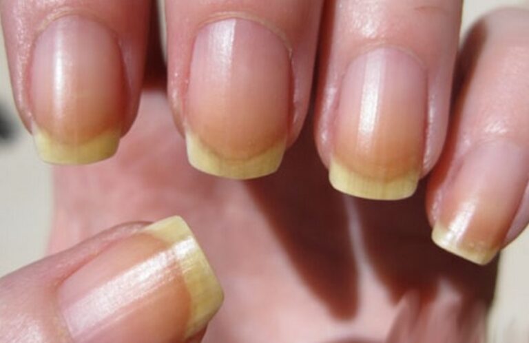sante ongle jaune