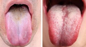 5 signes inquiétants que votre langue vous signale à propos de votre état de santé et de votre digestion