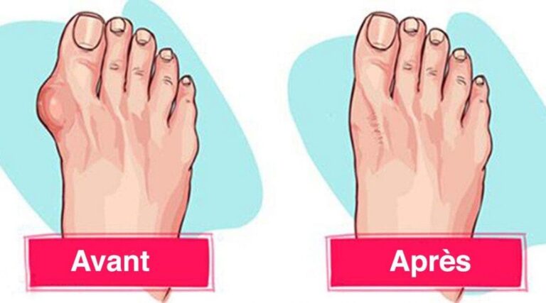 6 astuces utiles pour se debarrasser de la goutte 1 1 1200x667 1