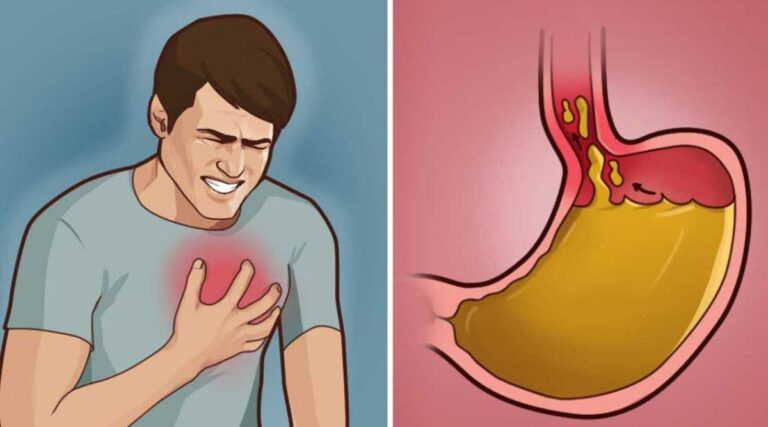 9 astuces naturelles de traiter les brulures destomac ou le reflux acide 1200x667 1