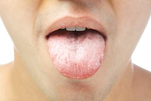 Langue blanche bouche levre main 12859127 9 façons de se débarrasser de la langue blanche et de la rendre plus saine