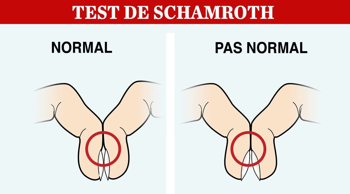 Test de Schamroth Ce simple test des doigts pourrait révéler des signes de cancer du poumon et d'autres problèmes de santé