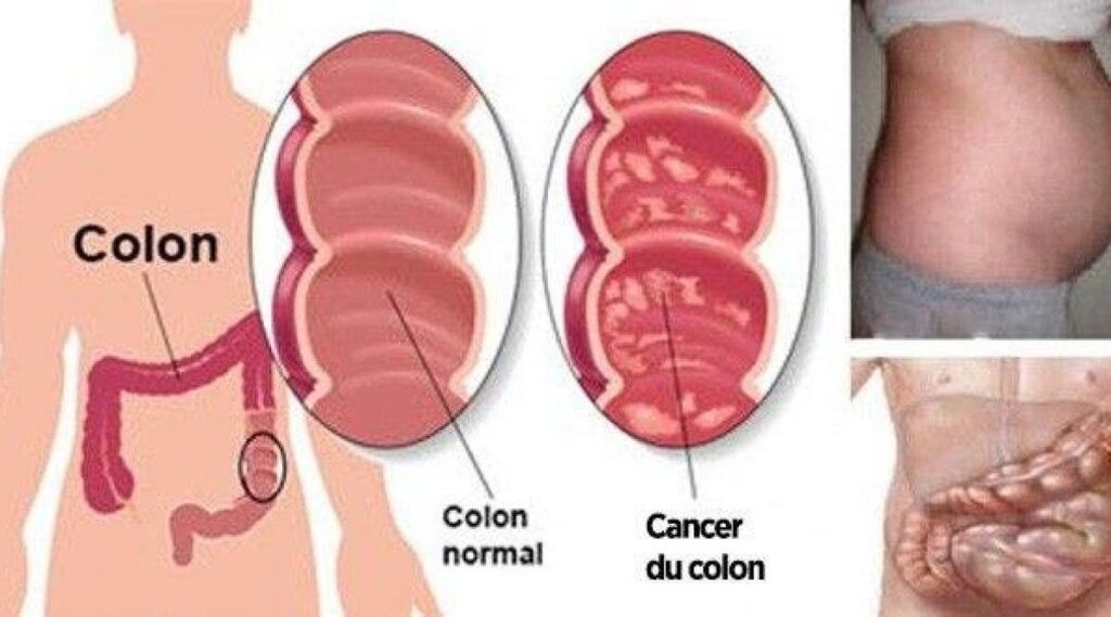 Voici les symptomes avant coureurs du cancer du colon 1 Voici les symptomes avant coureurs du cancer du colon 1