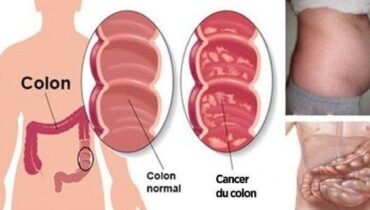 Voici les symptômes avant-coureurs du cancer du colon