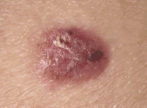 cancer spinocellulaire Comment détecter un cancer de la peau