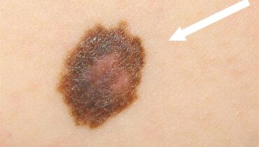Comment détecter un cancer de la peau