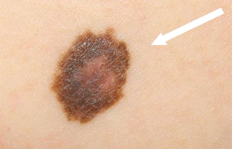 cncr1 Comment détecter un cancer de la peau