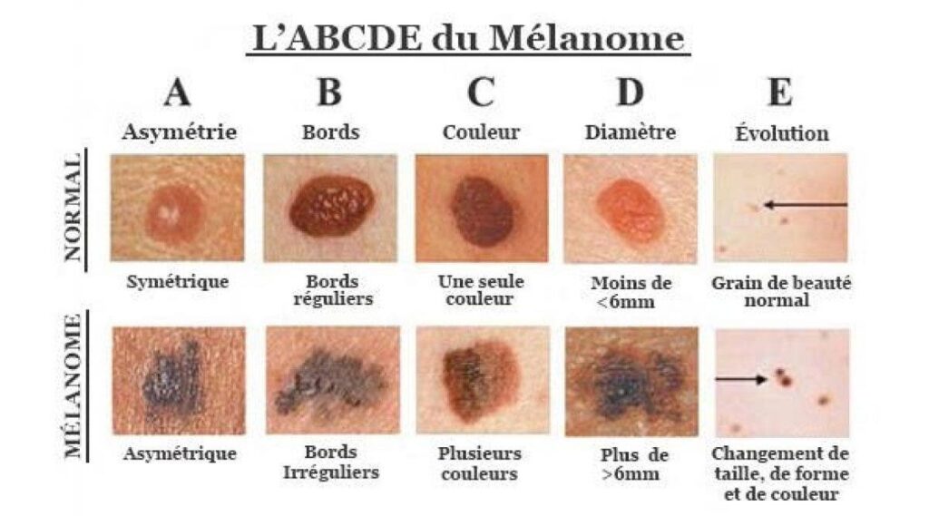Comment D tecter Un Cancer De La Peau tre Heureux Comment D tecter Un Cancer De La Peau tre Heureux