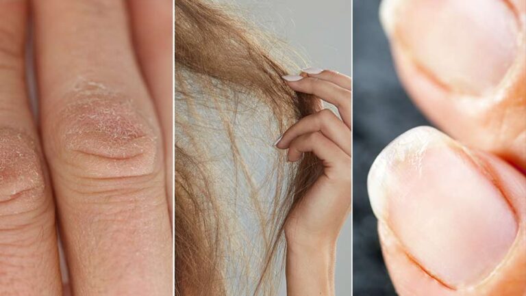 dry hair skin nails