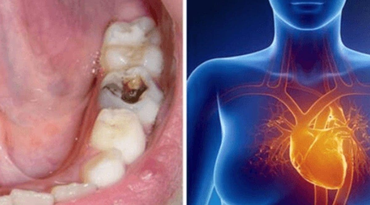 les caries dentaires peuvent causer une infection et toucher dautres organes du corps 1 1200x667 1 Comment votre santé dentaire peut avoir un impact sur les autres organes du corps