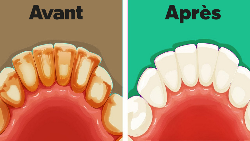 plaque dentaire1 Se débarrasser de la plaque dentaire : 6 méthodes naturelles