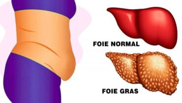 11 signes de la maladie du soda ou maladie du foie gras à détecter