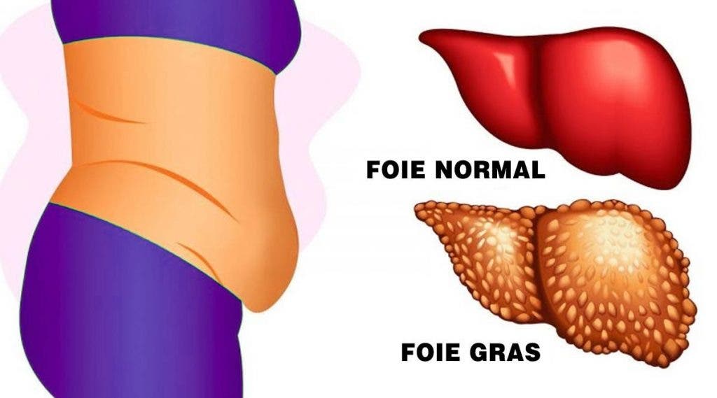 Un foie gras peut vous rendre malade et fatigue 6 signes a detecter 1024x569 1 11 signes de la maladie du soda ou maladie du foie gras à détecter