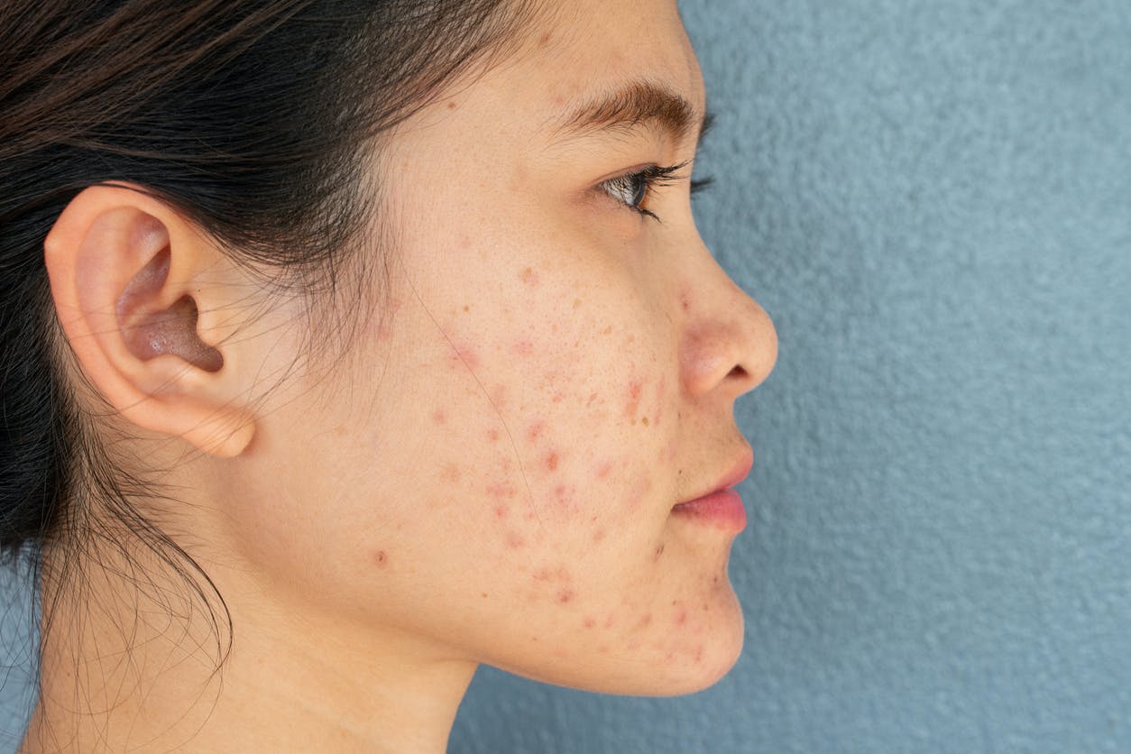 cicatrices acne comment retrouver une belle peau 4 remèdes naturels pour éliminer les marques de boutons et les verrues