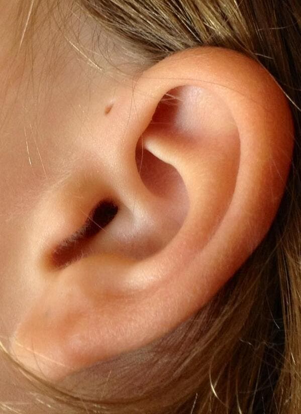 tai 2 1 1 Voici pourquoi certaines personnes ont un petit trou au-dessus de leurs oreilles