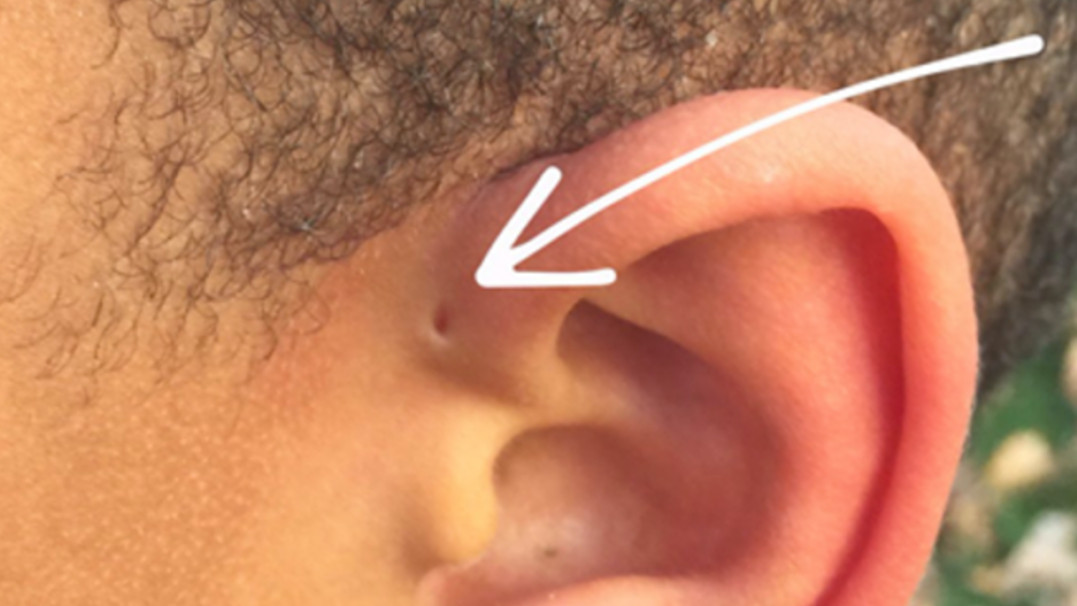 trou naissance oreille 7463be875468be0b408e0146417c1f88252d8d08 Voici pourquoi certaines personnes ont un petit trou au-dessus de leurs oreilles