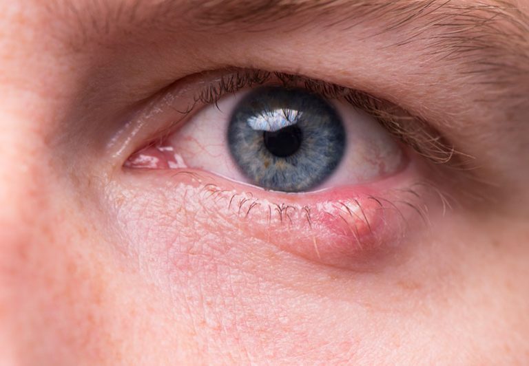 soigner orgelet naturellement œil yeux