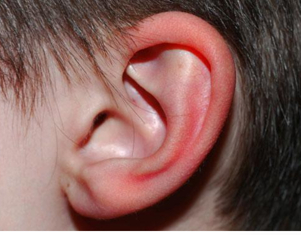 oreilles rouges et chaudes causes