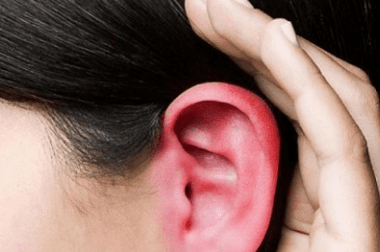 oreilles rouges et chaudes