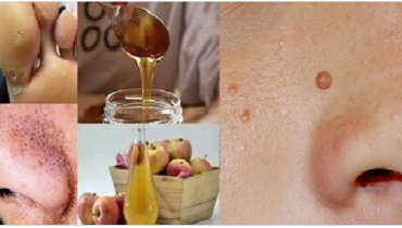 6 astuces pour se débarrasser des verrues, des taches brunes et des acrochordons 4 6 astuces pour se débarrasser des verrues, des taches brunes et des acrochordons les verrues des taches brunes acrochordons