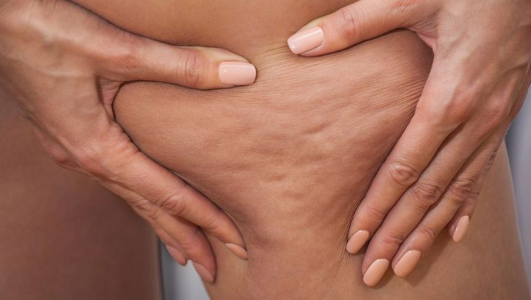 cellulite