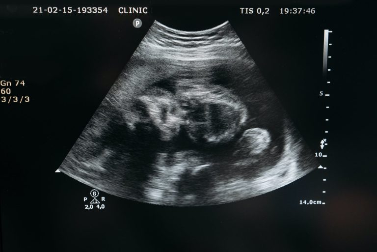échographie bébé