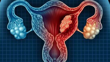 Le cancer de l'utérus