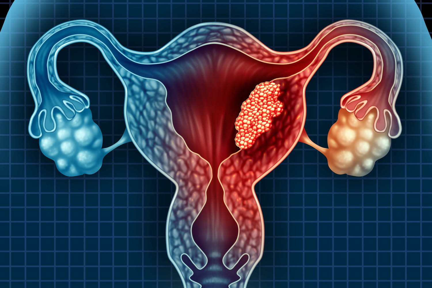 Le cancer de l'utérus