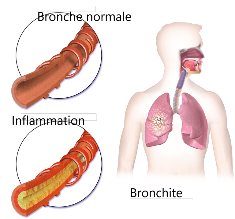 bronchite