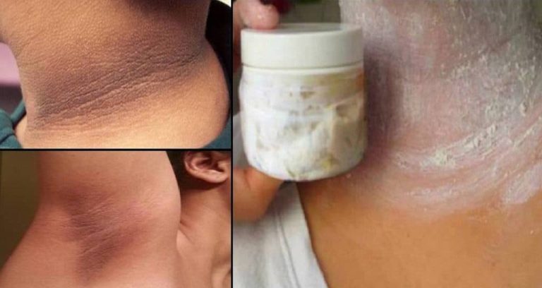 Traitement de l'hyperpigmentation à la maison