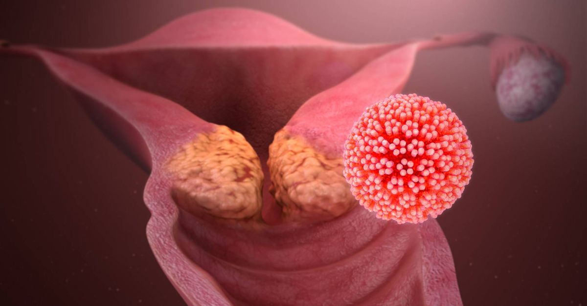Quelles sont les causes du cancer du col de l'utérus