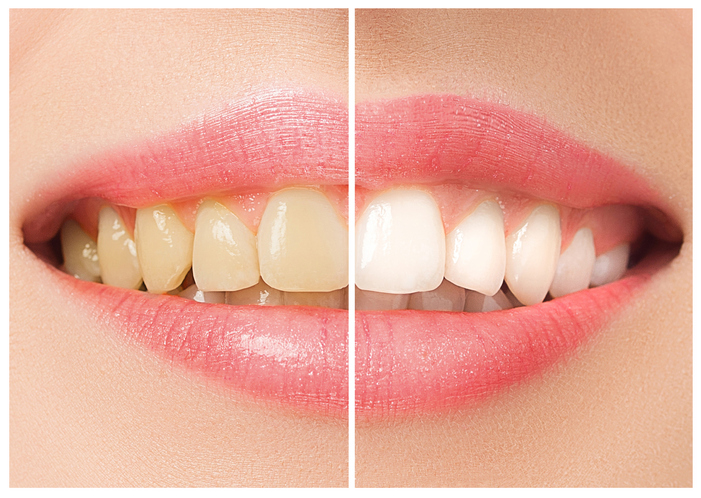 dents blanches et saines