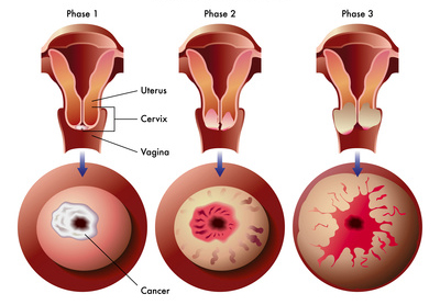 les symptômes et les signes du cancer du col de l'utérus