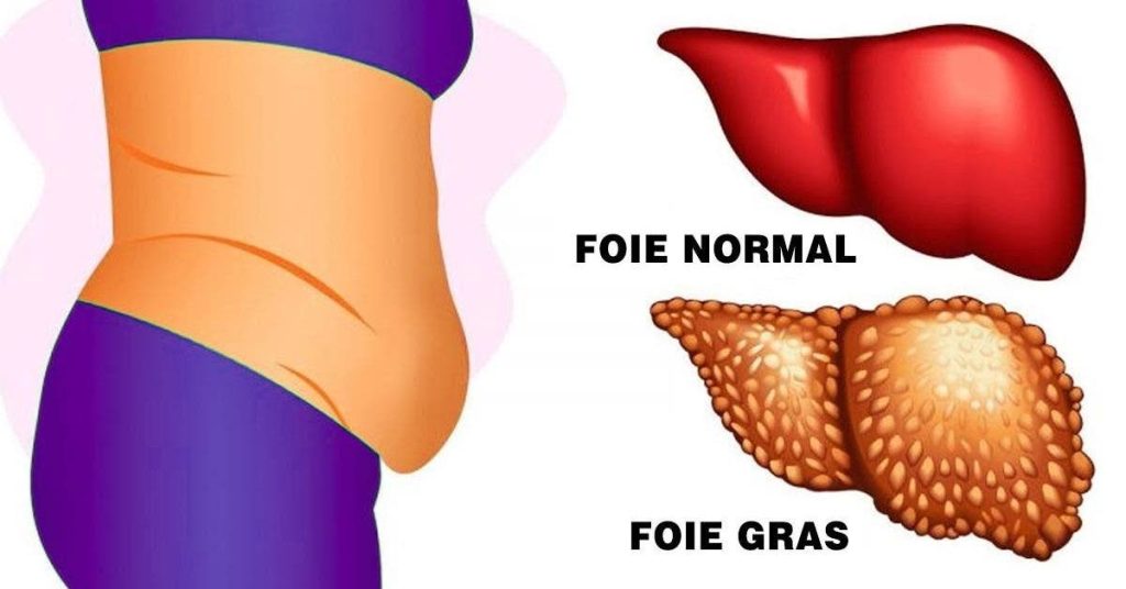 Qu’est-ce qui cause la maladie du foie gras ? Les conseils d’experts en matière de régime alimentaire pour gérer cette maladie la maladie du foie gras