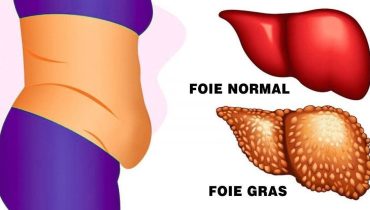 Qu’est-ce qui cause la maladie du foie gras ? Les conseils d’experts en matière de régime alimentaire pour gérer cette maladie