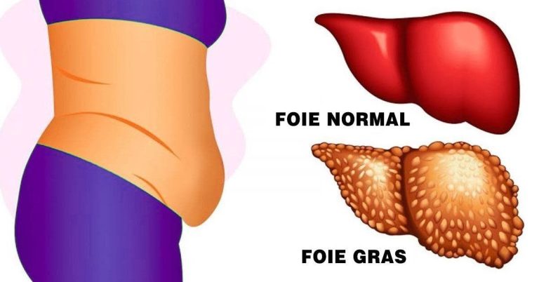 la maladie du foie gras