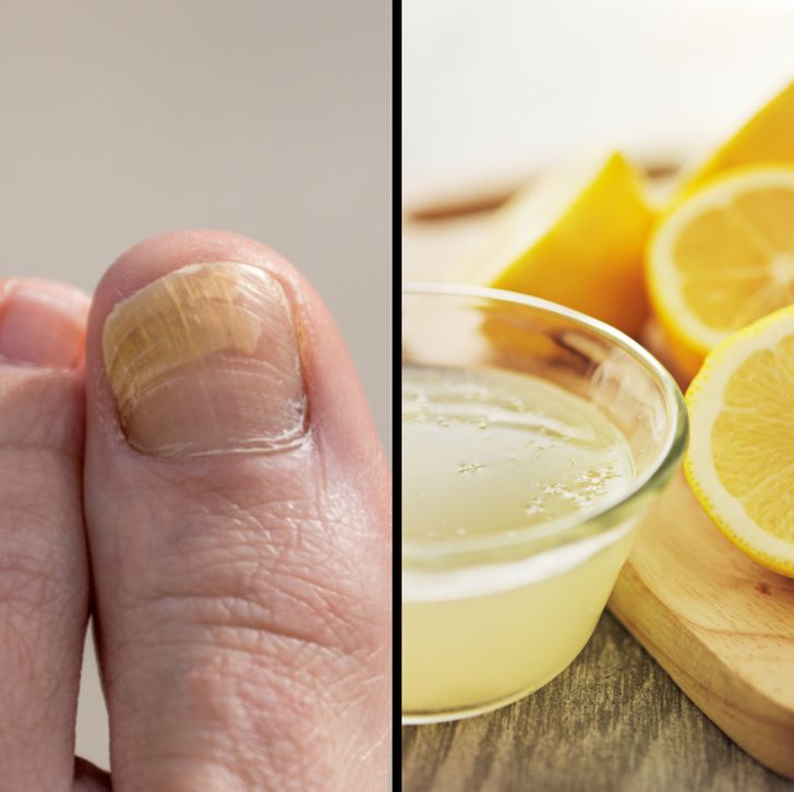 Bain au jus de citron pour les ongles d'orteil jaunes