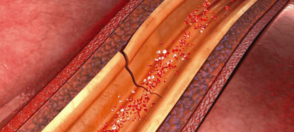 Dissection de l'artère coronaire