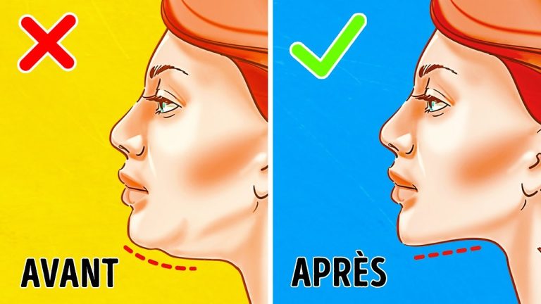 Le double menton, également appelé graisse sous-mentonnière