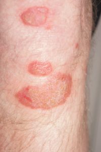 Psoriasis