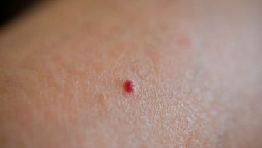 Que signifient ces 10 taches rouges sur votre peau ?