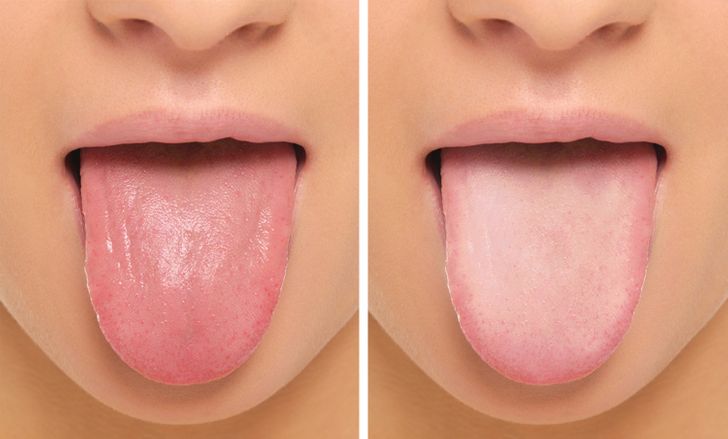 Gonflement/sensibilité de la langue et de la bouche
