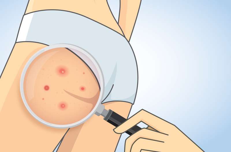 En ne portant pas de sous-vêtements, vous ne serez pas confrontée à l'acné des fesses