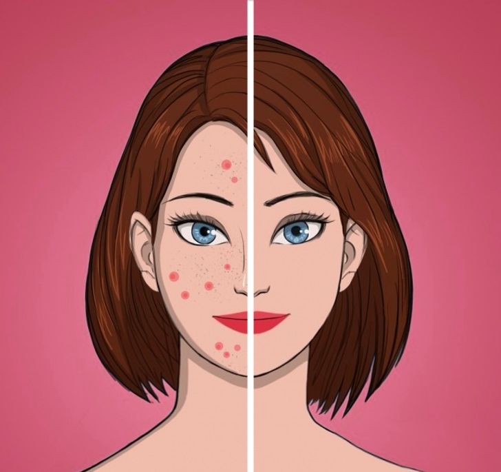 Prévenir l'acné