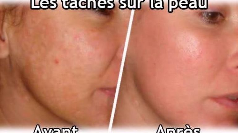 10 remèdes naturels contre les taches brunes comme une vraie gomme citron enzymes genoux HPV Jus de citron l’acrochordon la zone Les taches brunes les verrues mains maladies chroniques morceau naturelles organes génitaux papillomavirus peau protégée rapidement remèdes remèdes naturels s'améliorer se débarrasser des verrues sommeil taches brunes température températures verrues visage vraie gomme