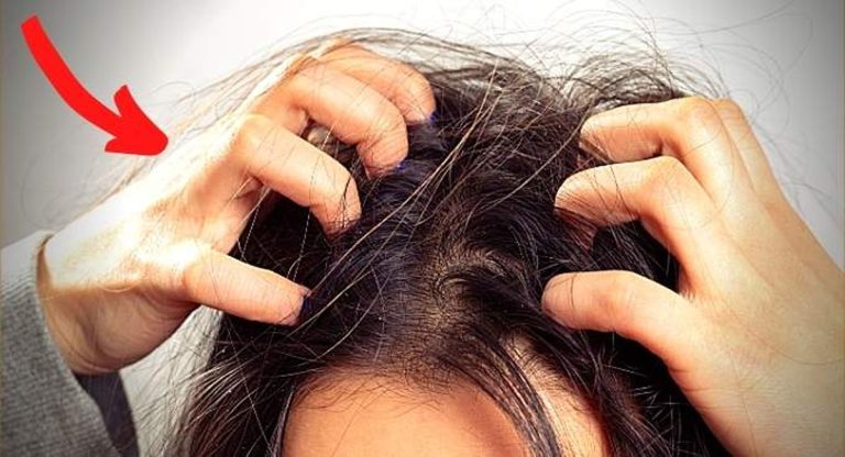 4 causes qui provoquent l&rsquo;acné du cuir chevelu et comment la traiter de façon naturelle00