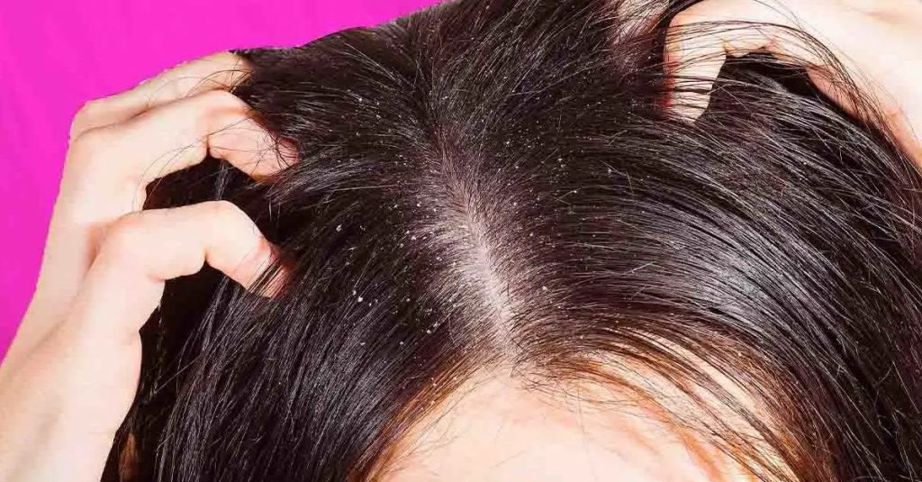 Comment Faire Pour Avoir Moins De Sebum Cheveux